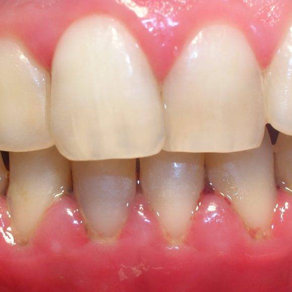 What is Gingivitis?